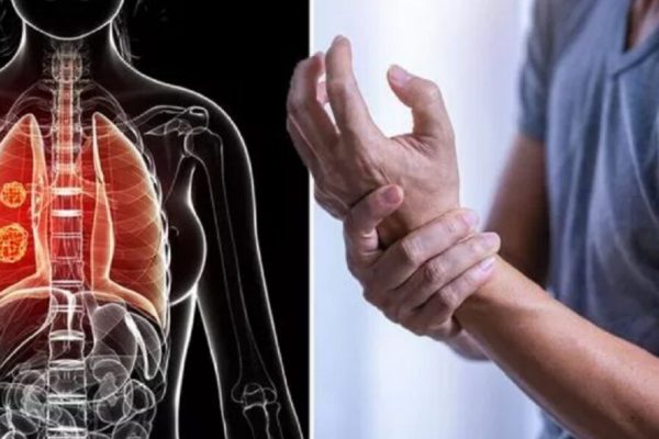 Semnele subtile ale cancerului pulmonar: Mâinile, indicatori esențiali în diagnosticarea timpurie
