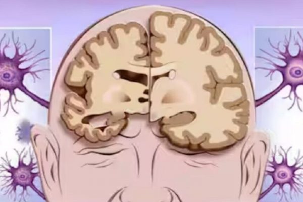 Alzheimer și Dieta: Cum Alimentația Poate Reduce Riscul de Demență cu Până la 53%