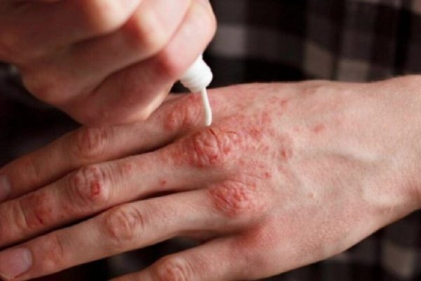 Lepra În Europa: O Boală Rară Întoarsă în Centrul Atenției Publice