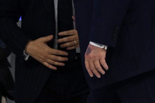 Donald Trump și Vânătaia Sa: O Privire Asupra Sănătății și Implicațiilor Publice
