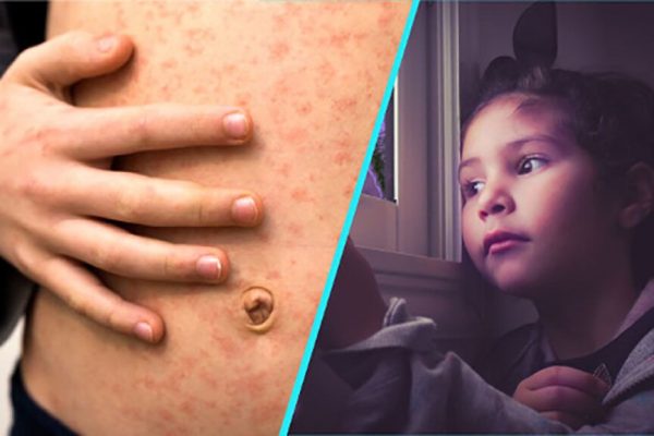 Revenirea rujeolei în Europa: o criză sanitară alarmantă și implicațiile sale pentru sănătatea publică