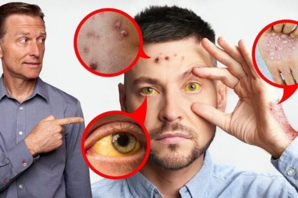 Semnele Ficatului Gras: 5 Indicatori Vizibili pe Față și Gât care Pot Anunța Probleme Hepatice Grave