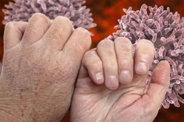 Semnele hipotiroidismului: Cum ne avertizează unghiile despre sănătatea noastră