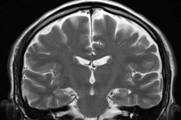 Deficiența de Vitamina B12: O Amenințare Silențioasă pentru Sănătatea Creierului și Legătura cu Boala Alzheimer
