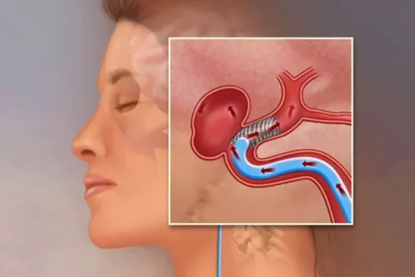 Semnalele tăcute ale anevrismului cerebral: O amenințare ignorată de milioane