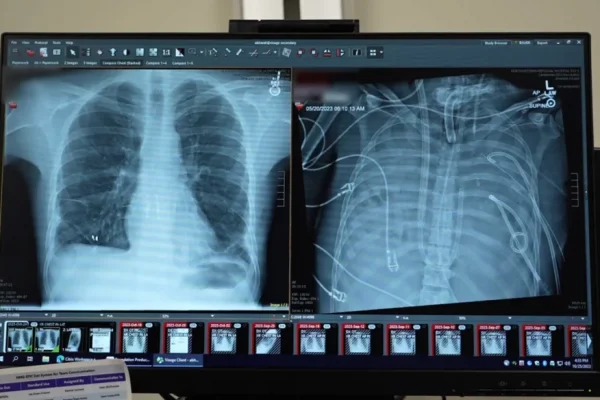 Inovația medicală care poate transforma viitorul transplanturilor pulmonare: Plămânii artificiali care salvează vieți