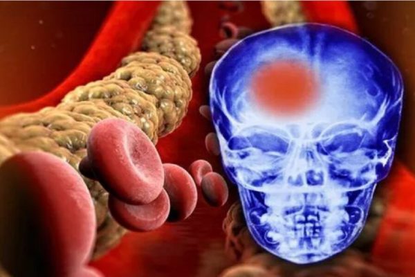 Influența trigliceridelor asupra sănătății cognitive: Cum grăsimile din sânge afectează memoria și concentrarea