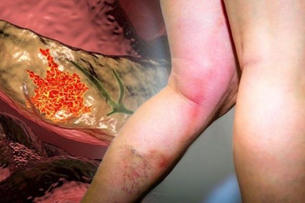 Cancerul pancreatic: Semnele subtile care pot anunța o boală letală