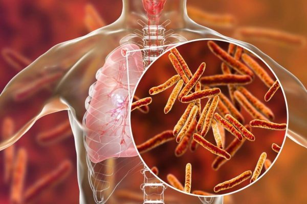 Revenirea Tuberculozei: O Amenințare Subestimată în Europa