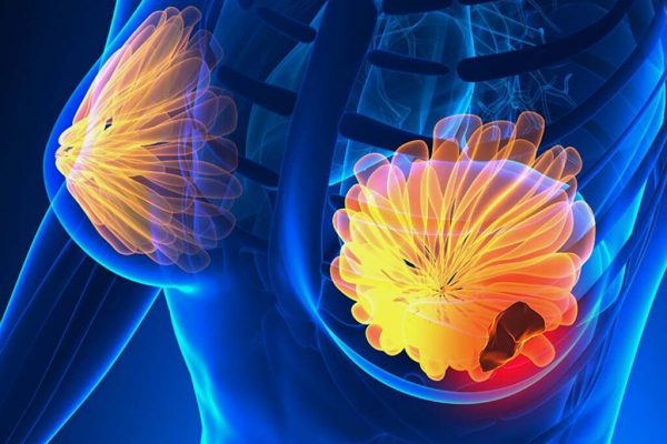 Inteligența Artificială Revoluționează Screeningul pentru Cancerul de Sân: Un Studiu Inovator