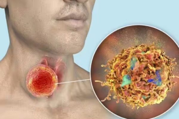 Cum să detectezi nodulul tiroidian potențial cancerigen: Ghidul expertului endocrinolog
