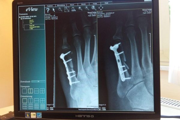 Fracturile osoase: un semnal de alarmă pentru cancerul avansat de prostată