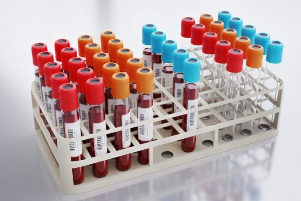 Revoluția în depistarea cancerului pancreatic: O analiză de sânge promițătoare pentru diagnosticarea timpurie