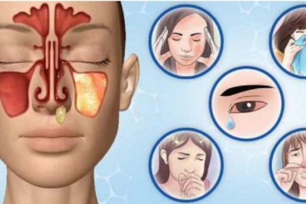 Sinuzita: De ce trebuie să fii atent la simptome și să consulți un medic