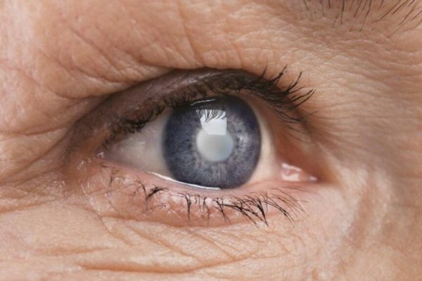 Inegalitatea de gen în sănătatea oculară: De ce femeile suferă mai mult de cataractă decât bărbații?