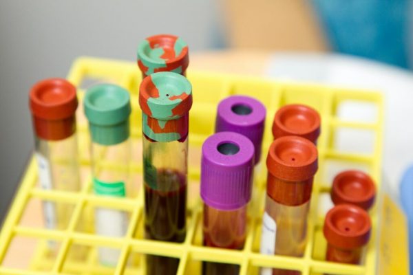 Cresterea ALT-ului la analizele de sange: Semne de alarma pentru sanatatea ficatului si masuri preventive