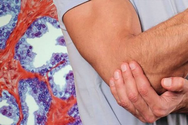 Semnele cutanate ale cancerului de prostată: Avertismente pe care bărbații nu ar trebui să le ignore