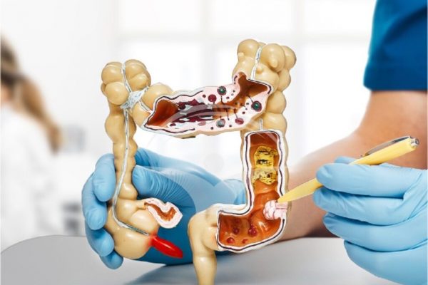 Simptomele timpurii ale cancerului de colon: Ce trebuie să știm pentru un diagnostic precoce