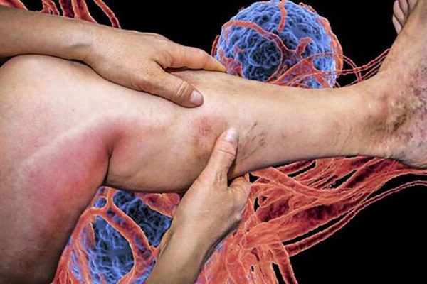 Durere și amorțeală la picioare: Semnele diabetului care pot indica complicații grave