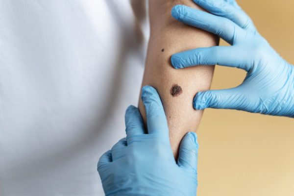 Alunițele: Semnale ale sănătății pielii și riscuri de cancer. Cum să le identifici corect