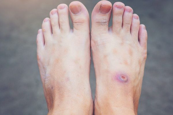 Semnele diabetului: Picioarele uscate, un simptom crucial care nu trebuie ignorat