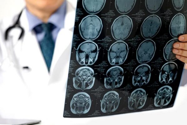 Apolipoproteina B: Markerul crucial pentru prevenirea accidentului vascular cerebral care depășește colesterolul
