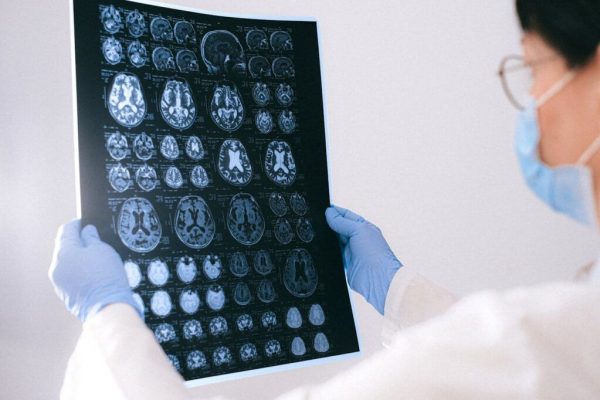 Semnele Ascunse ale Tumorilor Cerebrale: Ce Trebuie Să Știi pentru a Nu Ignora Sănătatea Ta