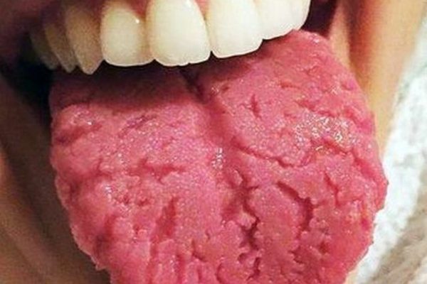 Limba Crăpată: Semne, Cauze și Remedii Naturale pentru O Sănătate Orală Optimă