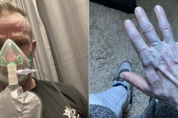 Culoarea albastră a pielii: O poveste medicală surprinzătoare și lecții despre siguranța lenjeriei de pat