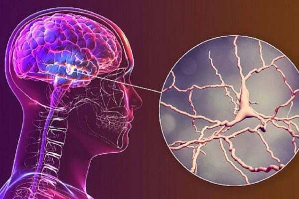 Semnele Timpurii ale Bolii Parkinson: Ce Trebuie Să Știe Românii
