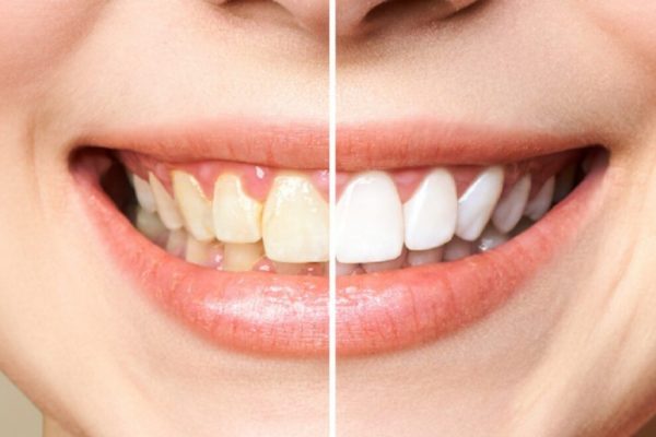 Îngălbenirea dinților: cauze, soluții și impactul asupra sănătății dentare