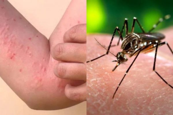 Chikungunya: O Amenințare Virală în Expansiune în Europa