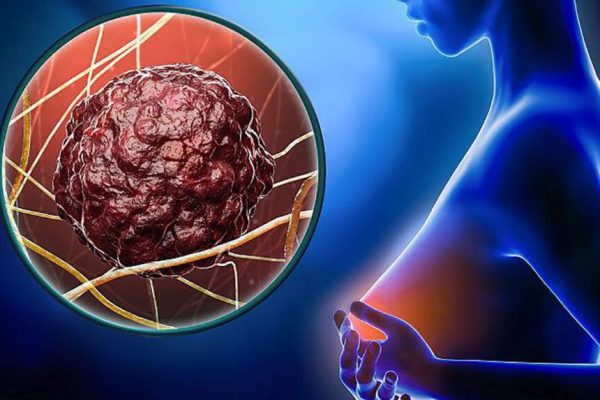 Ivermectina: Un Medicament Antiparazitar cu Potențial în Combaterea Cancerului de Sân Rezistent la Tratament