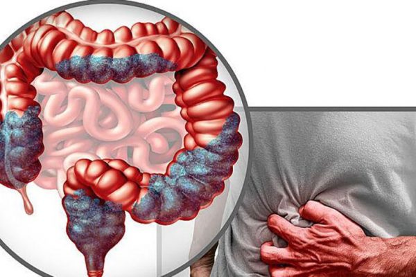 Aspirina: Un Medicament Vechi cu Noi Speranțe în Lupta Împotriva Cancerului Colorectal