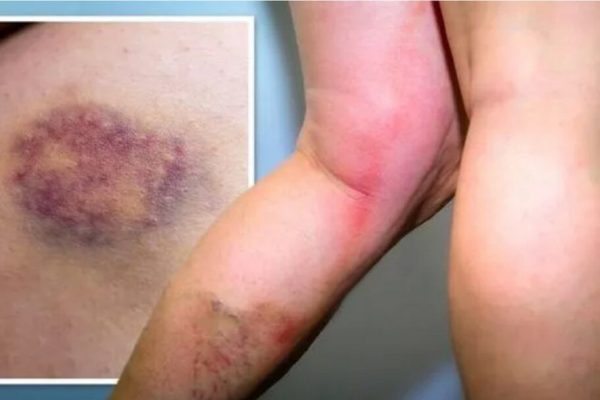 Ceaiul Verde: O Băutură Sănătoasă pentru Prevenirea Cheagurilor de Sânge
