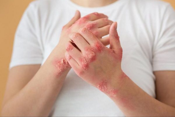 Inovație în tratamentul dermatologic: Spitalul din Hunedoara introduce fototerapia pentru psoriazis și vitiligo