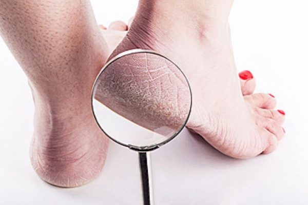 Avertizările unui Medic: Culoarea Călcâielor Ca Indiciu al Problemelor Hepatice