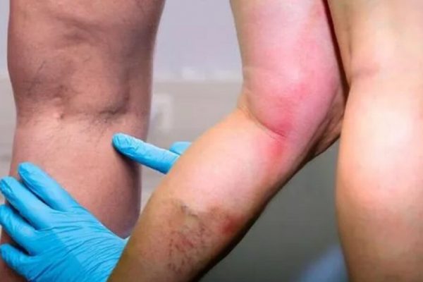 Vitamina E: Protectorul Inimii și Susținătorul Sistemului Imunitar în Lupta Contra Cheagurilor de Sânge