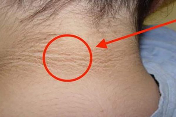 Semnele ascunse ale diabetului: Pata de pe gât care nu trebuie ignorată