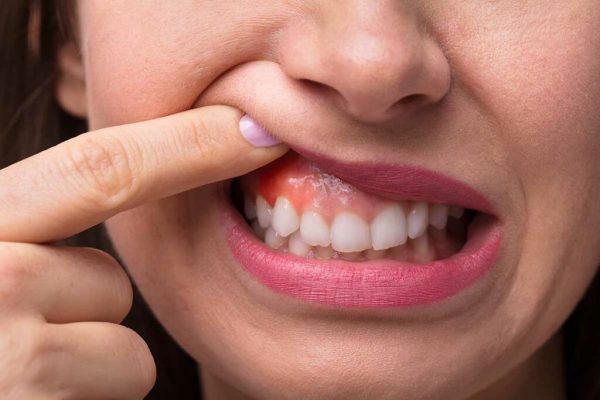 Cancerul oral în România: O criză silențioasă care necesită atenție urgentă