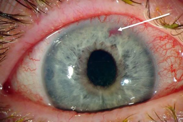 Glaucomul: Avertismentul care ar putea salva vederea ta