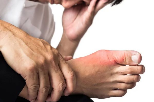 Impactul hiperuricemiei asimptomatice: Eroziunea articulară și riscurile asociate pentru sănătate