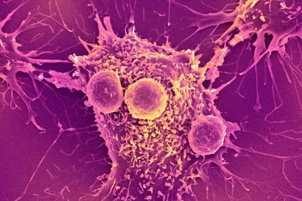 Sara Gore, Prezentatoarea TV, Împărtășește Lupta sa cu Cancerul de Sân: O Poveste de Speranță și Reziliență