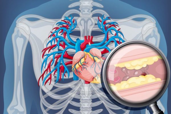Colesterolul Remnant: O Nouă Amenințare în Sănătatea Cardiovasculară