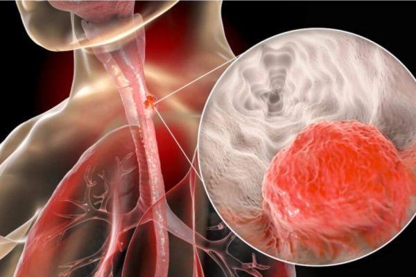 Prevenția cancerului: Cum obiceiurile de viață pot reduce semnificativ riscul de îmbolnăvire