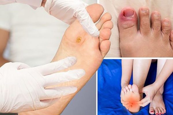 Atenție la durerea de picioare: un simptom ignorat al diabetului care poate duce la complicații severe