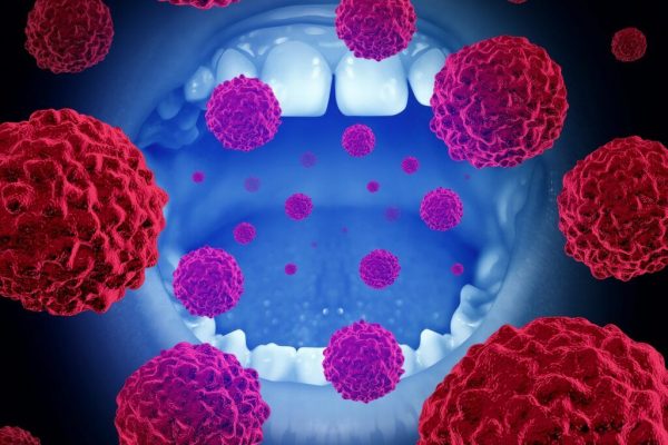 Cancerul oral: O amenințare silențioasă care necesită atenție sporită