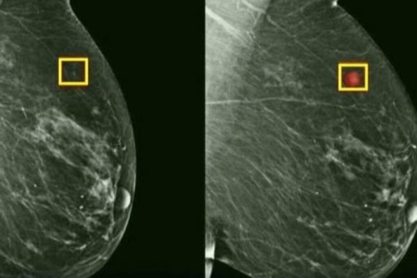 Povestea unei oncologe: diagnosticarea surprinzătoare a cancerului mamar fără simptome evidente