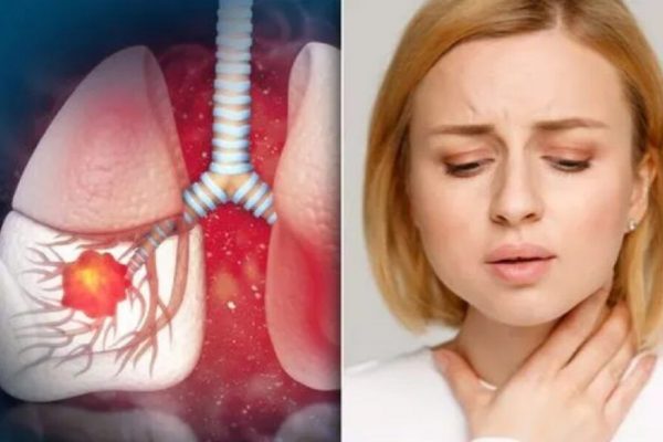Semnele Timpurii ale Cancerului Pulmonar: Atenție la Ce Nu Trebuie Ignorat