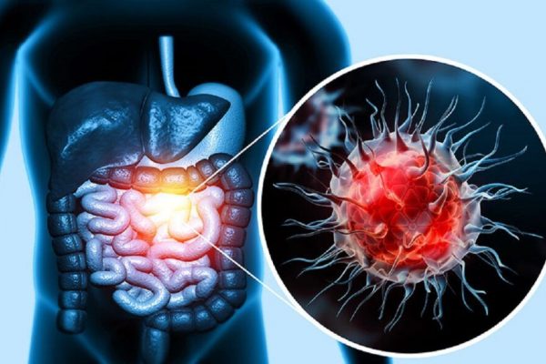 Povestea lui Ruth Lloyd-Williams: Lupta împotriva cancerului de colon și impactul diagnosticelor eronate